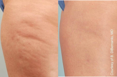 Cellulaze before and after photo