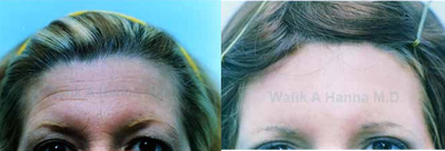 Dysport before and after photo