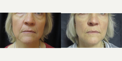 Bellafill before and after photo