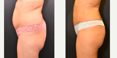 Brazilian Butt Lift before and after photo