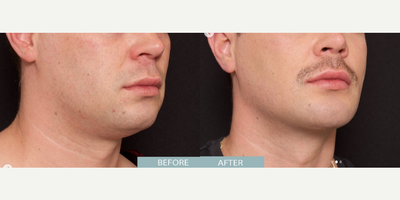 Chin Implant before and after photo