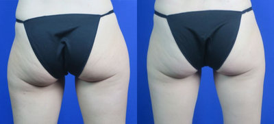 CoolSculpting before and after photo