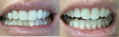 Dental Crown before and after photo