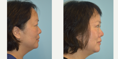 Double Eyelid Surgery before and after photo