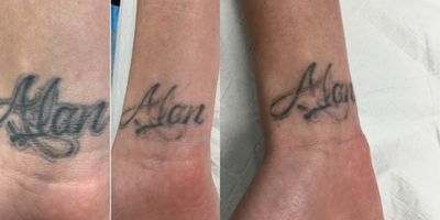 Tattoo Removal before and after photo