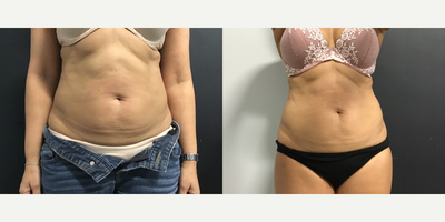 Emsculpt before and after photo