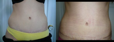 Smart Lipo before and after photo
