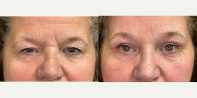 Brow Lift before and after photo