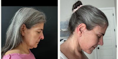 Deep Plane Facelift before and after photo