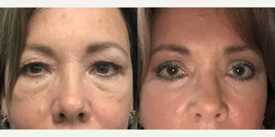 Eyelid Surgery before and after photo