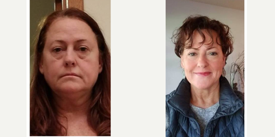 Gastric Sleeve Surgery before and after photo