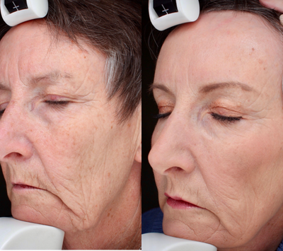 Liquid Facelift before and after photo