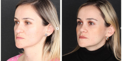 Rhinoplasty before and after photo