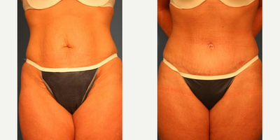 Tummy Tuck before and after photo
