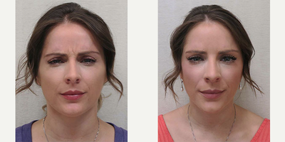 Botox before and after photo