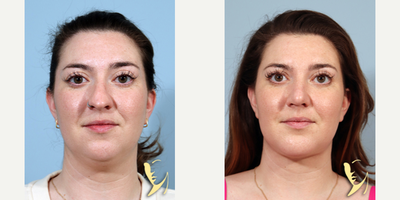 Chin Implant before and after photo