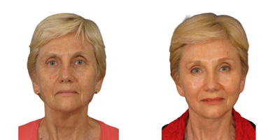 Eyelid Surgery before and after photo