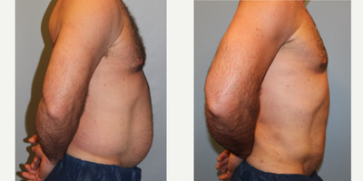 Liposuction before and after photo