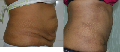 Tummy Tuck before and after photo