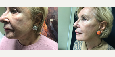Voluma before and after photo