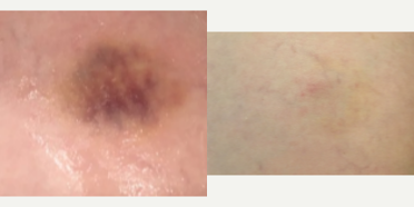 Excel V before and after photo