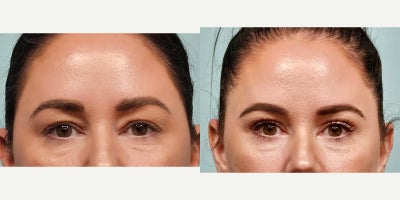 Eyelid Surgery before and after photo