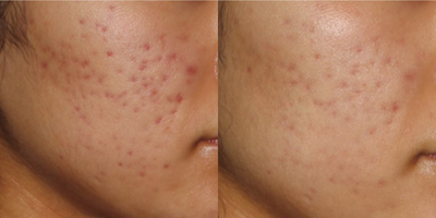 Infini RF before and after photo