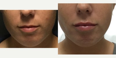 Restylane before and after photo