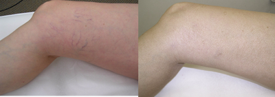 Sclerotherapy before and after photo
