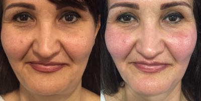 Fractional Laser before and after photo