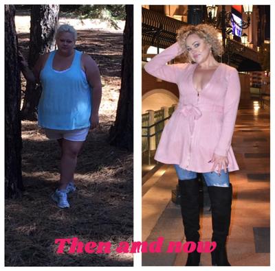 Gastric Sleeve Surgery before and after photo