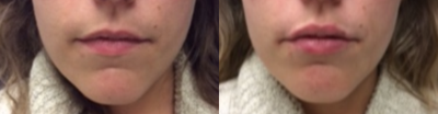 Lip Fillers before and after photo