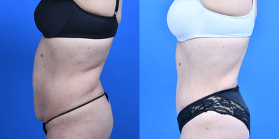 SAFELipo before and after photo