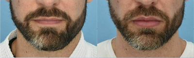 Vollure before and after photo