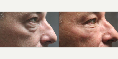 Eyelid Surgery before and after photo