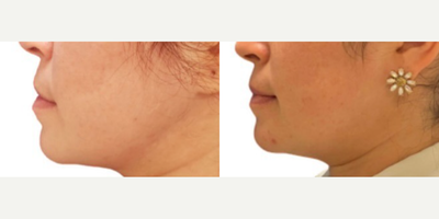 Genioplasty before and after photo