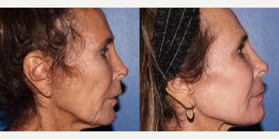 Laser Resurfacing before and after photo