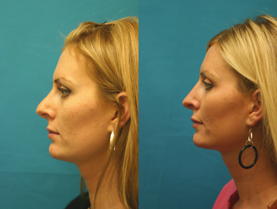 Rhinoplasty before and after photo