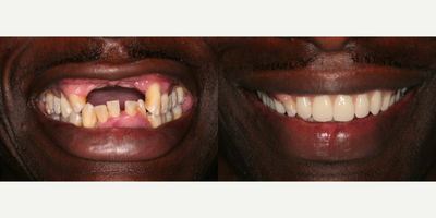 Smile Makeover before and after photo