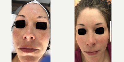 Halo Laser before and after photo