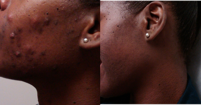 Accutane before and after photo