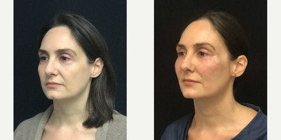 Facial Fat Transfer before and after photo