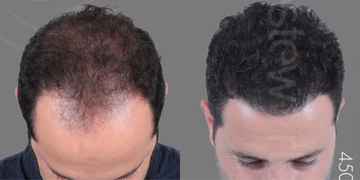 FUE Hair Transplant before and after photo