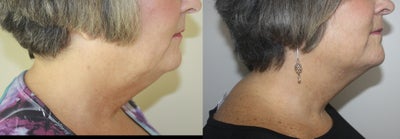 Kybella before and after photo
