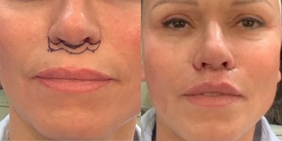 Lip Lift before and after photo