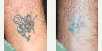 Tattoo Removal before and after photo
