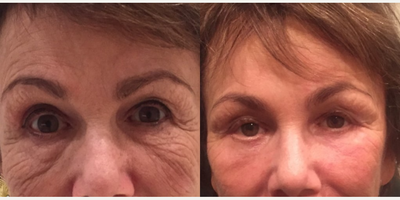 Dermal Fillers before and after photo