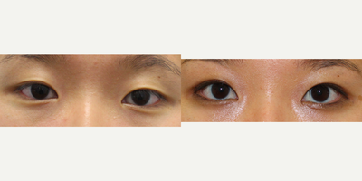 Double Eyelid Surgery before and after photo