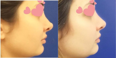 Nonsurgical Nose Job before and after photo