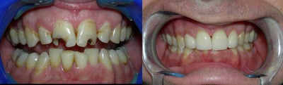 Smile Makeover before and after photo